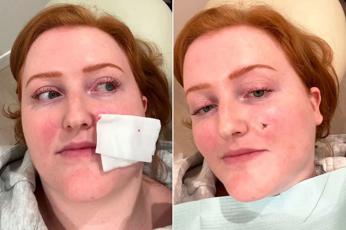 Kate O'Brien membagikan pengalaman menghapus tahi lalat aneh di kulit