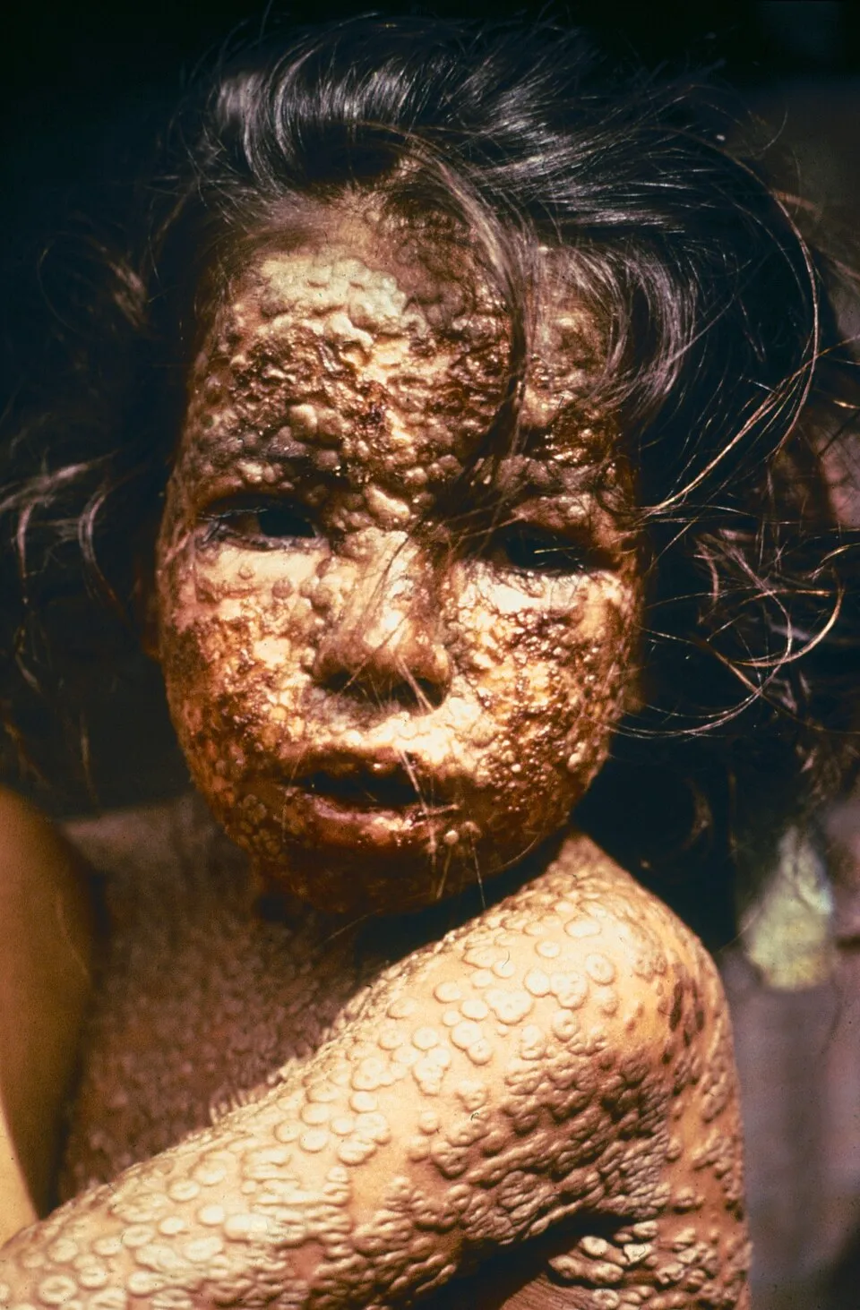 Sejarah smallpox penyakit menular yang berhasil diberantas oleh WHO