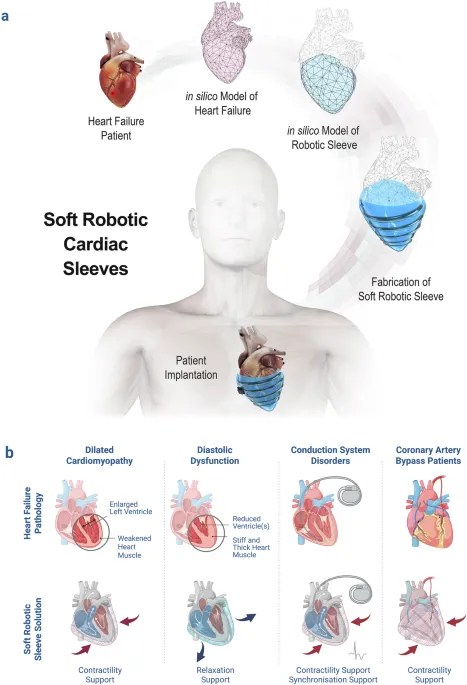 Ilustrasi teknologi soft robotic cardiac sleeves untuk penanganan gagal jantung